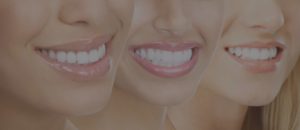 ortodonzia invisibile Smiletech